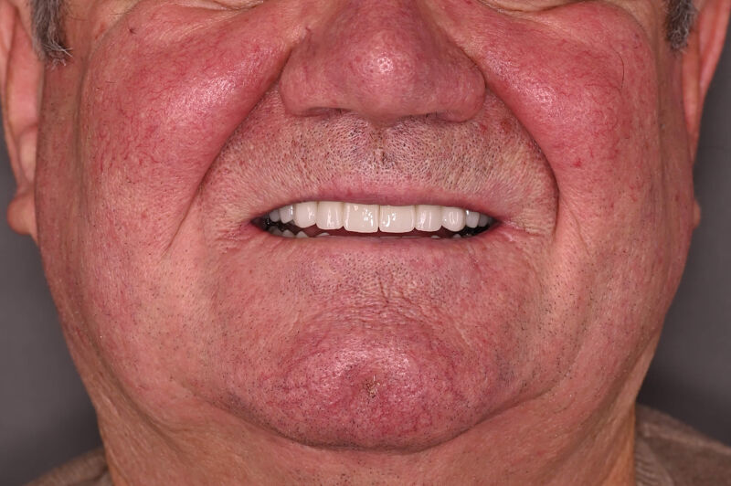 Zâmbet lateral stanga_dupa